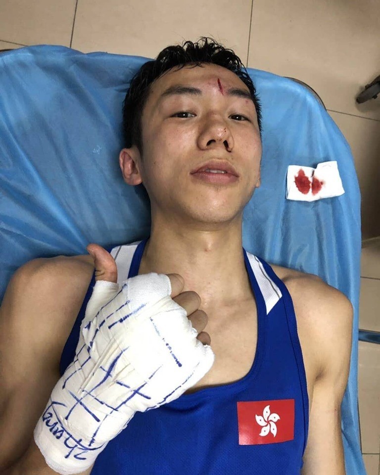 Rex Tso gives the thumbs up after requiring eight stitches for a head wound suffered during a Shanghai amateur bout. Photo: Rex Tso/Facebook