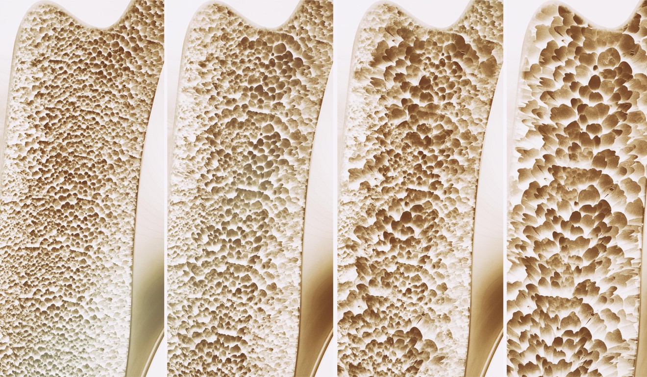 Osteoporosis is more likely to affect older women. Photo: Alamy