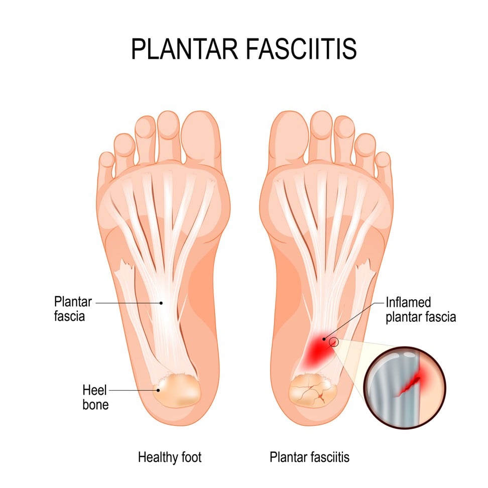 Plantar fasciitis is a disorder of the connective tissue which supports the arch of the foot.