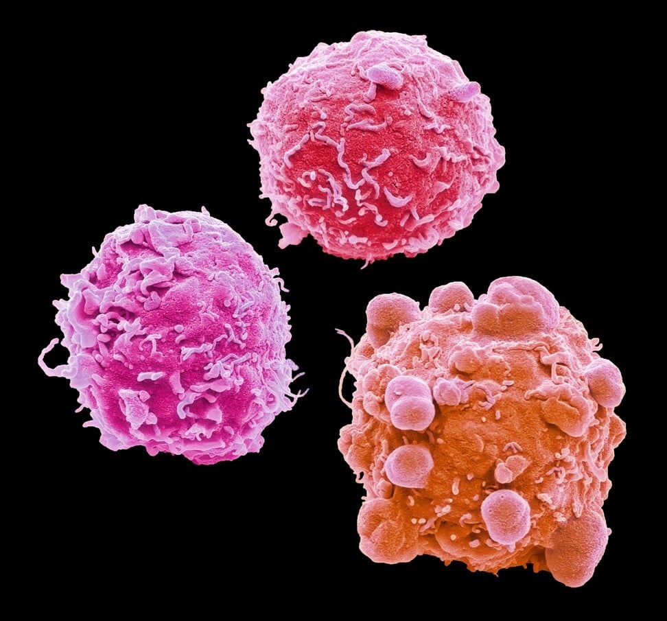 Colorectal cancer cells. Cancer treatment is normally a race against time, but public health care treatment can take months to start. Photo: Alamy