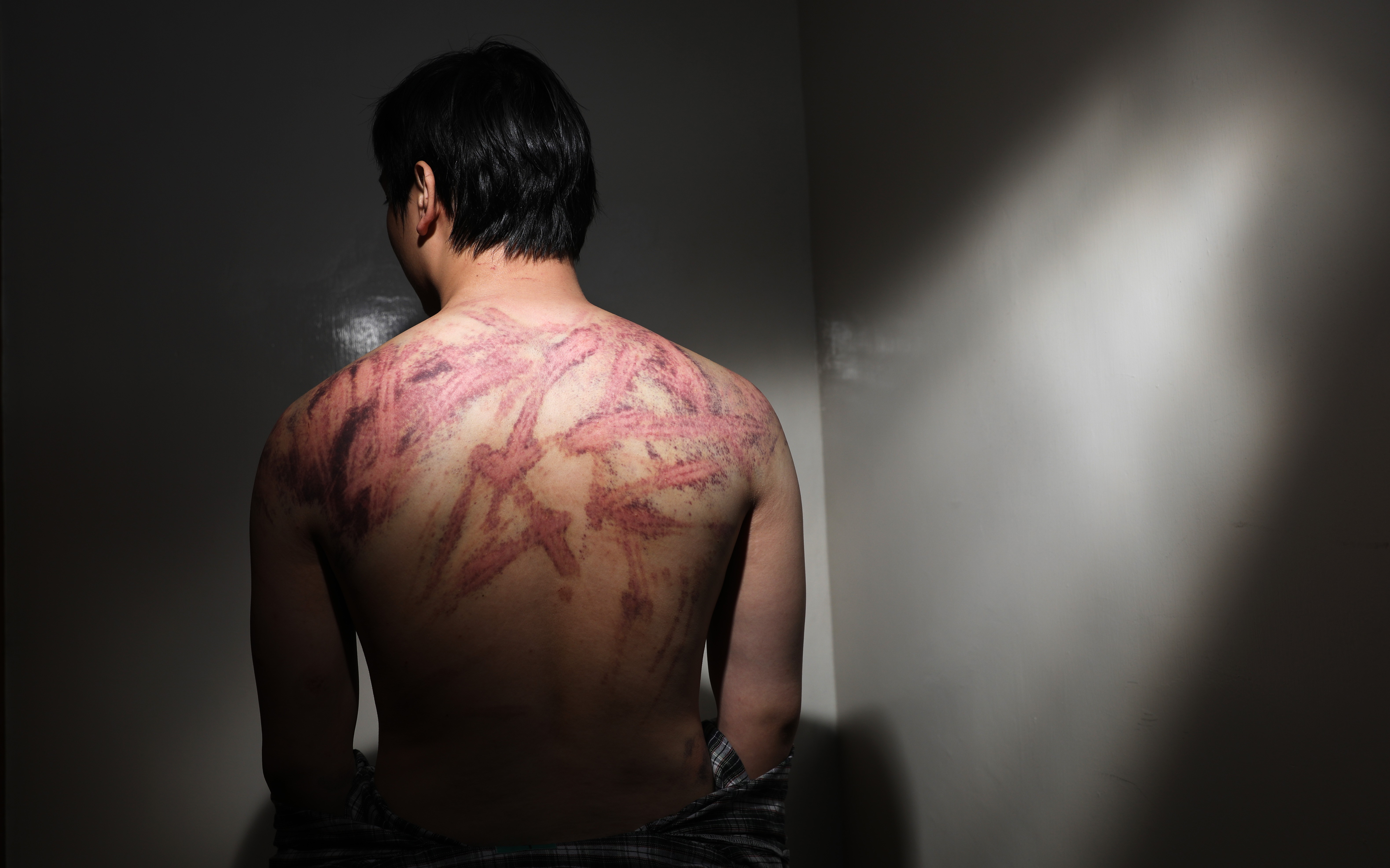 Calvin So shows the marks on his back caused by a brutal attack near Yuen Long MTR station on Sunday night. Photo: Sam Tsang
