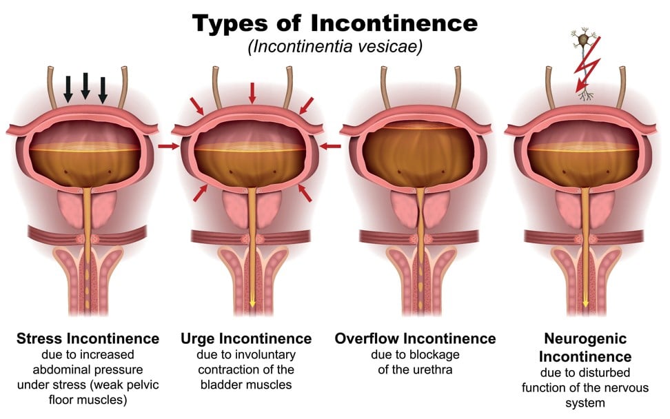 The different types of incontinence. Photo: Alamy