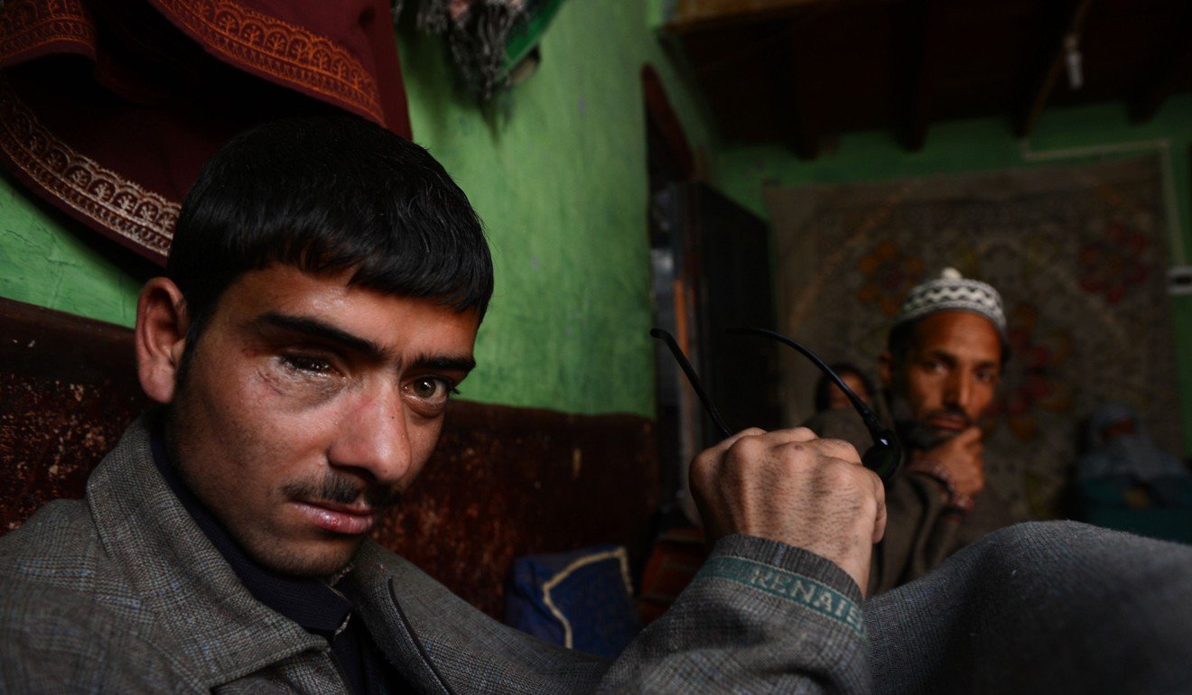 An 18-year-old Kashmiri who lost his right eye to a pellet gun fired by Indian police. Photo: AFP