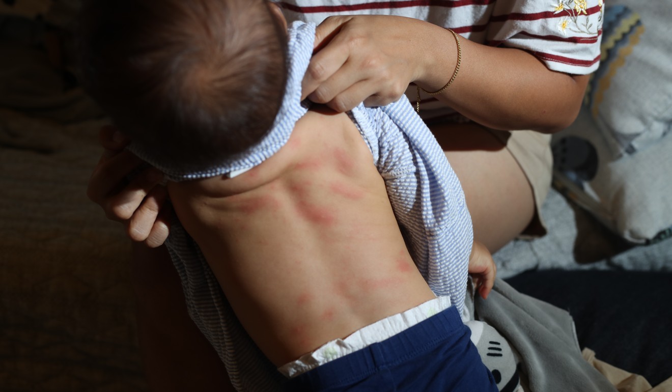 Mimi was left with rashes all over her back and front. Photo: Winson Wong
