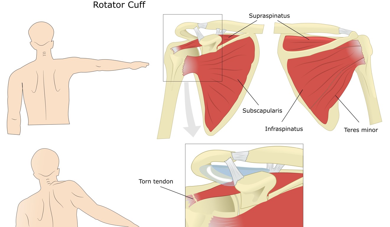 (Top) A normal rotator cuff – the four muscles that rotate the shoulder – and (bottom) with a torn tendon. Illustration: Shutterstock