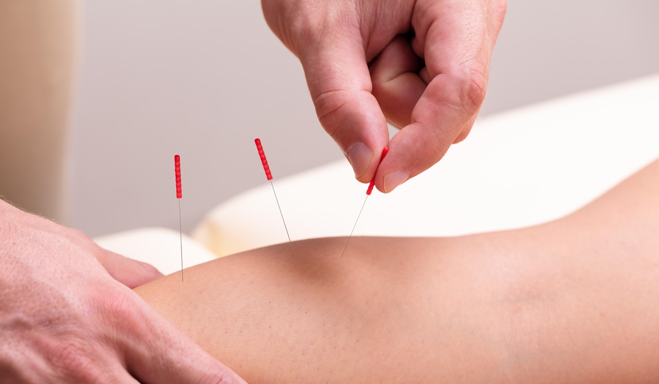 Alternative treatments for knee pain include acupuncture. Photo: Alamy