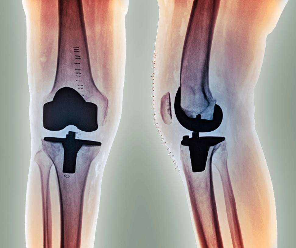 An estimated 1.3 million Americans a year will undergo knee replacement by 2030. Photo: Alamy