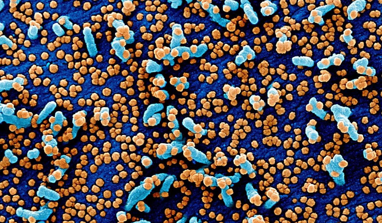 A colour electron micrograph of a Vero E6 cell (blue) heavily infected with Sars-Cov-2 virus (orange) isolated from a patient sample. Photo: Reuters