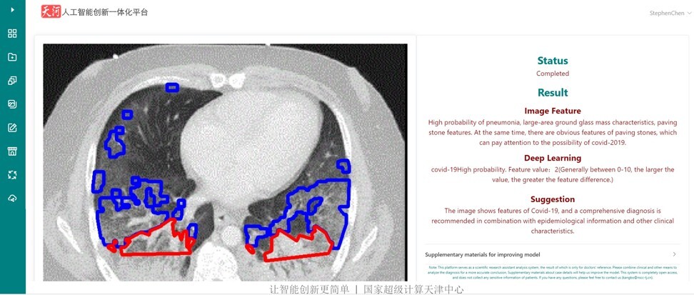 The Tianhe-1 supercomputer AI diagnosis report for a North Carolina patient with mysterious lung infection. Photo: National Supercomputing Centre in Tianjin