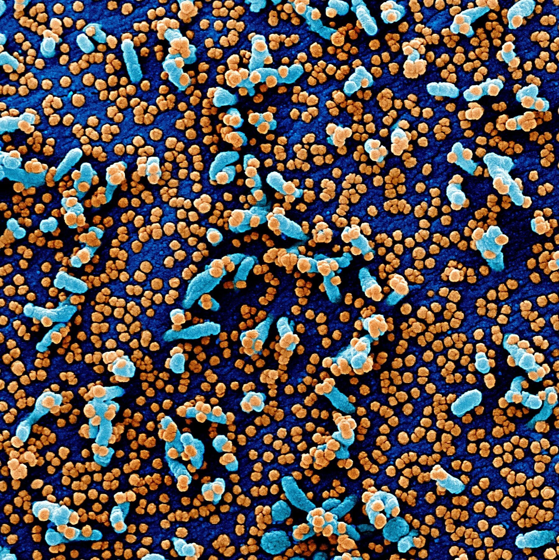 A colourised scanning electron micrograph supplied by the US National Institute of Allergy and Infectious Diseases shows a monkey kidney cell (blue) heavily infected with novel coronavirus particles (orange), which were isolated from a patient sample. Photo: Reuters