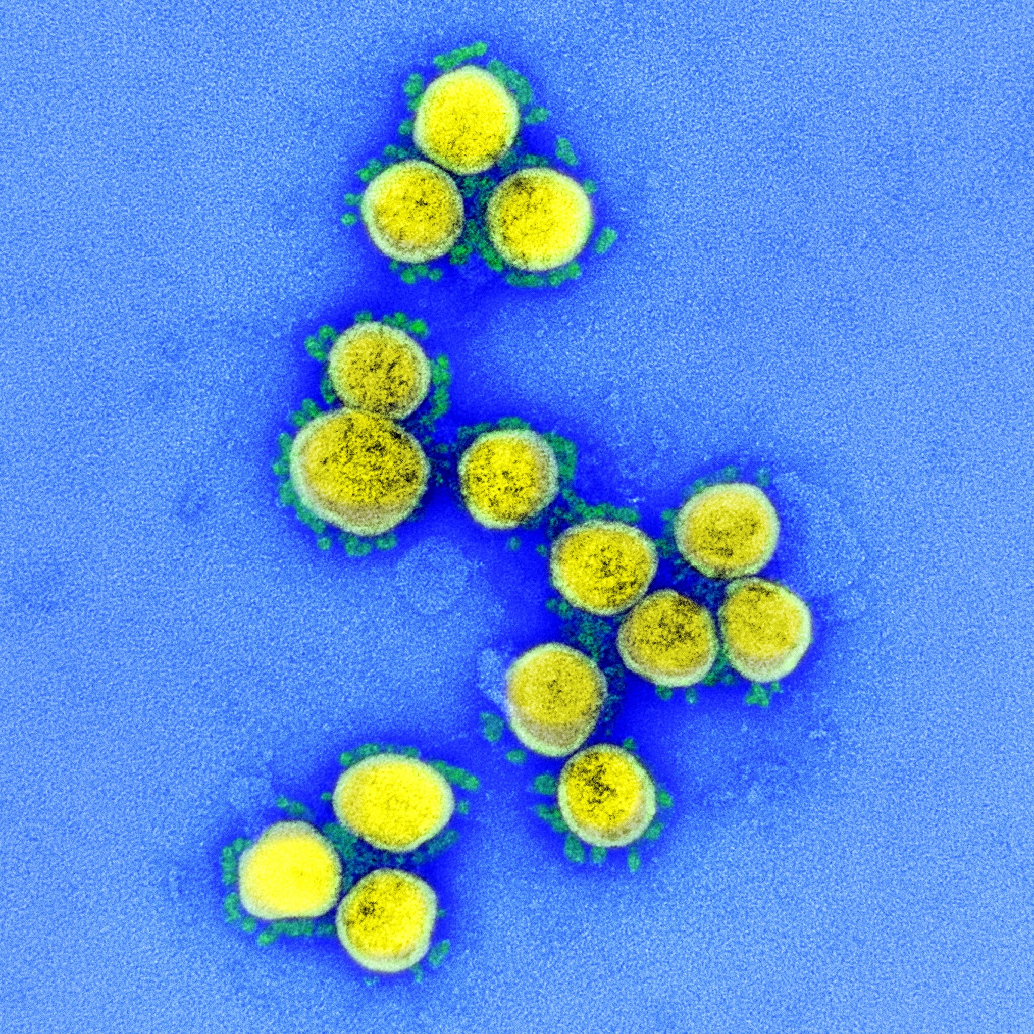 A transmission electron micrograph image of Sars-CoV-2 virus particles, isolated from a patient. Photo: EPA-EFE/NIAID/National Institutes of Health handout