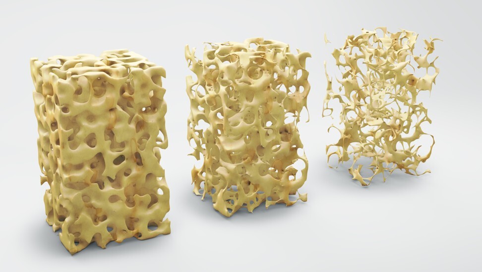This illustration shows how normal bone density is drastically reduced through osteoporosis. Photo: Shutterstock