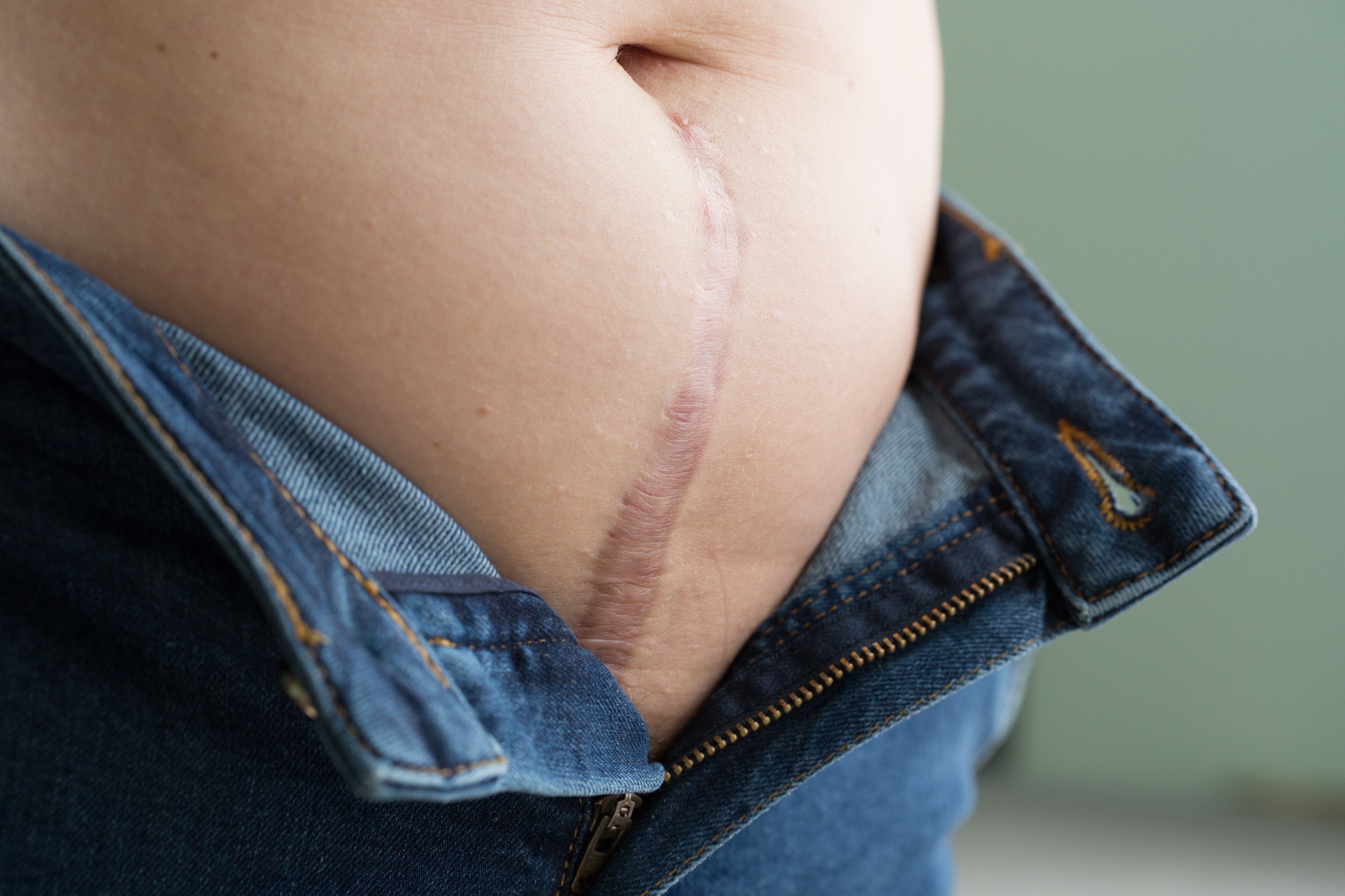 The writer wanted to avoid a hysterectomy scar like this. Photo: Getty Images