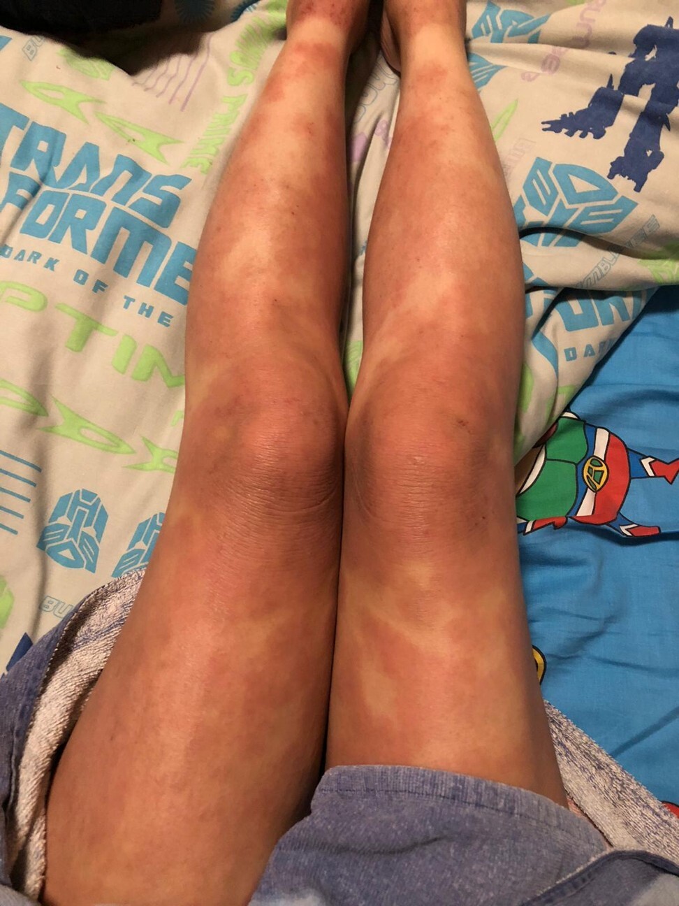 Kung documents an eczema outbreak on her legs.