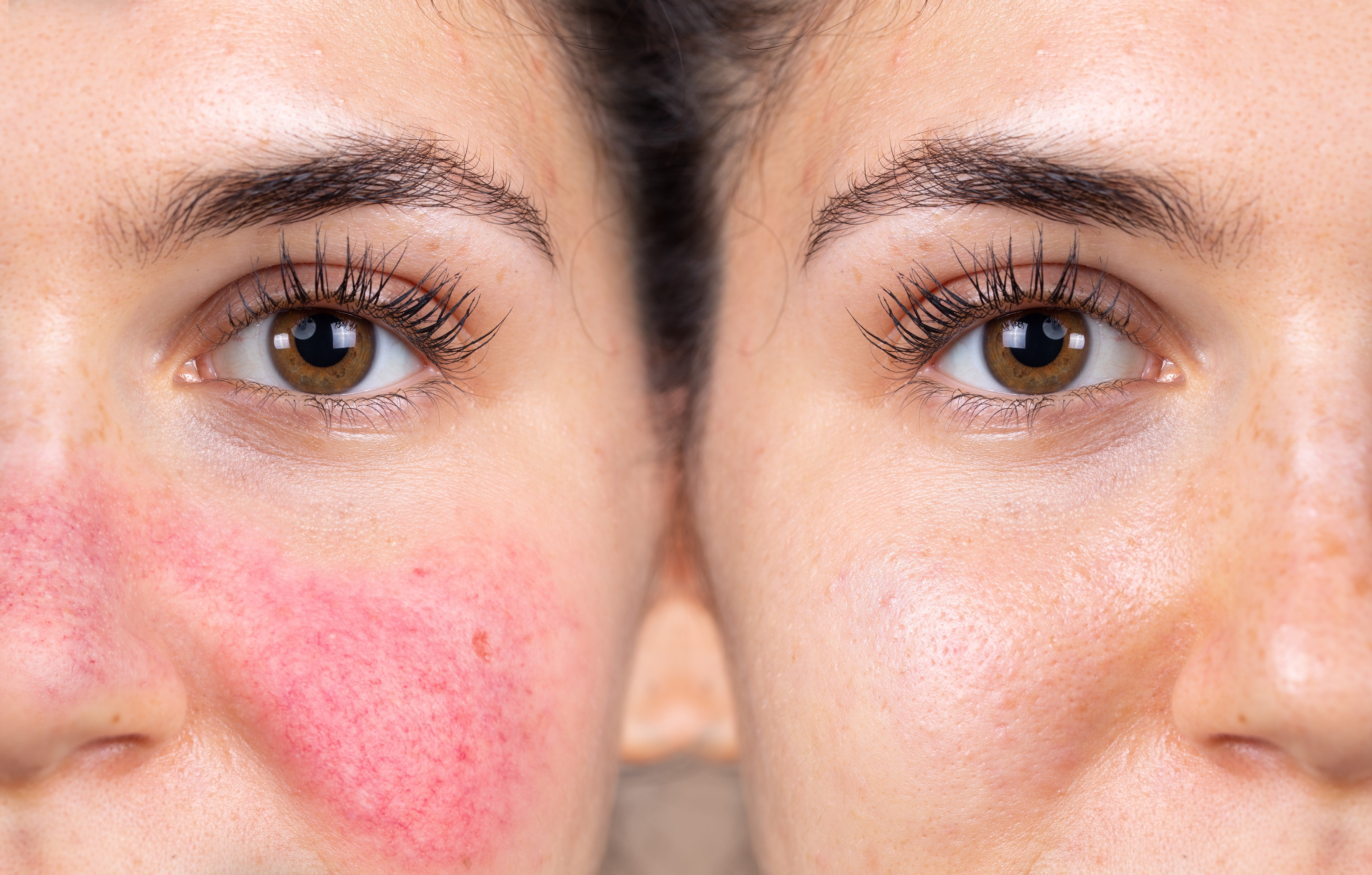 Rosacea happens to people whose skin is supersensitive, and makes it more so. Its cause is not yet well understood. Sufferers can control and mask it, though. Photo: Shutterstock