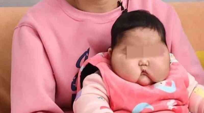 A steroid cream has been pulled from shelves in China after it caused a baby to develop a protruding, hairy forehead and cheeks and her weight to balloon.
