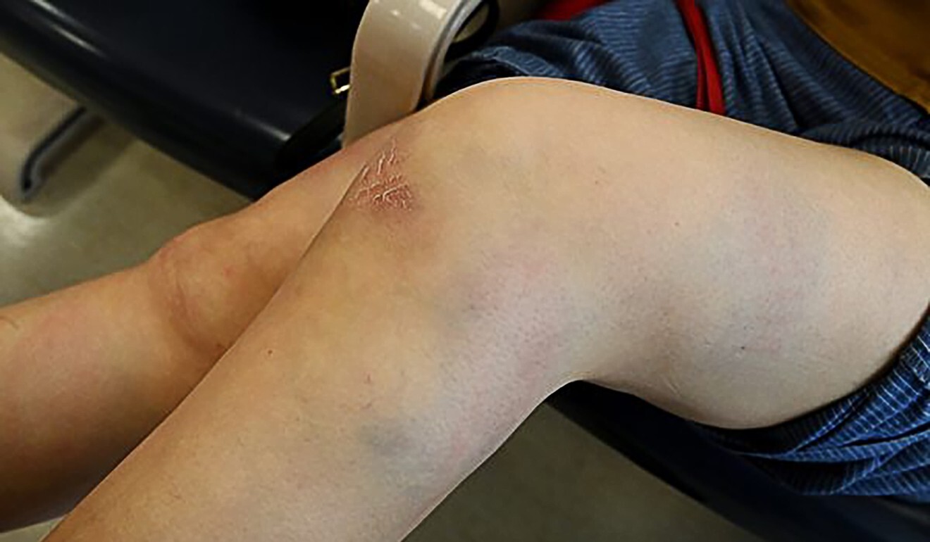 Injuries the woman sustained from the beating. Photo: The Epoch Times