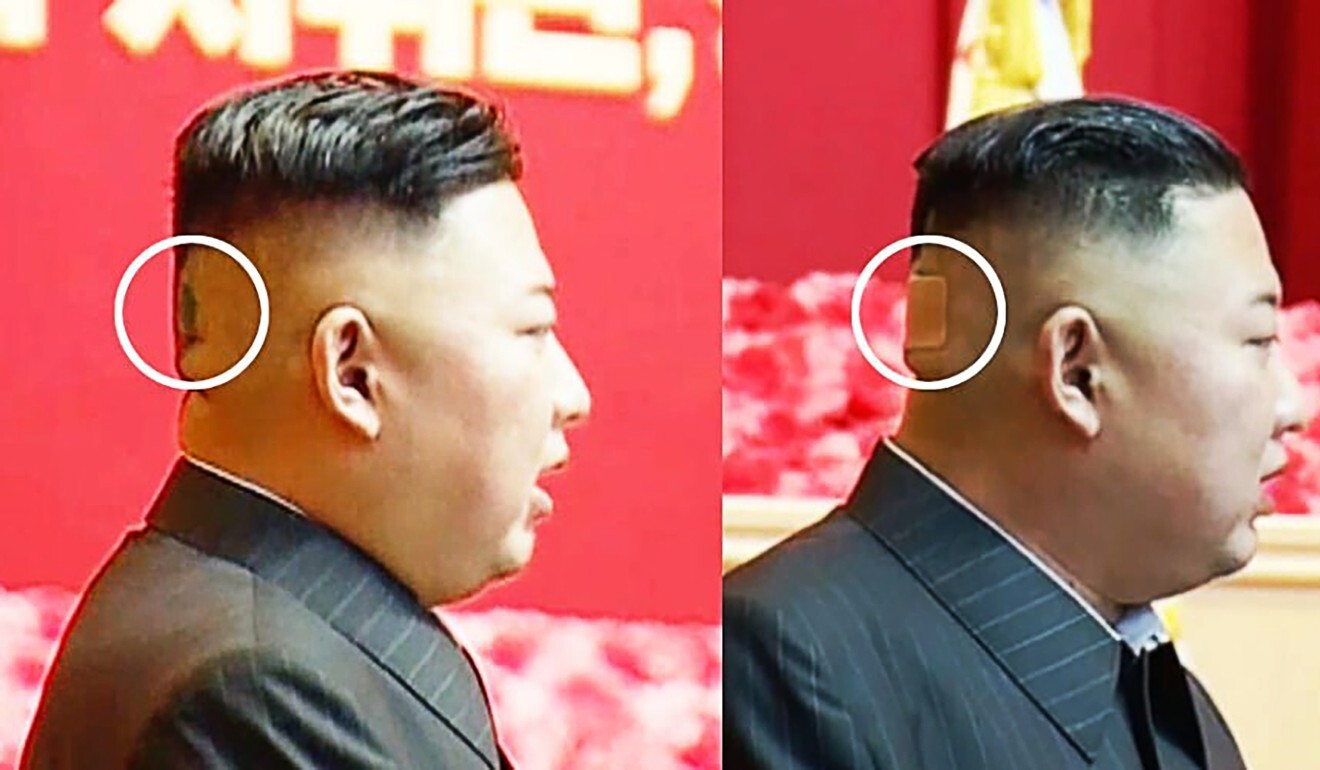 North Korean leader Kim Jong-un appeared with a bandage across the back of his head. Photo: KCNA