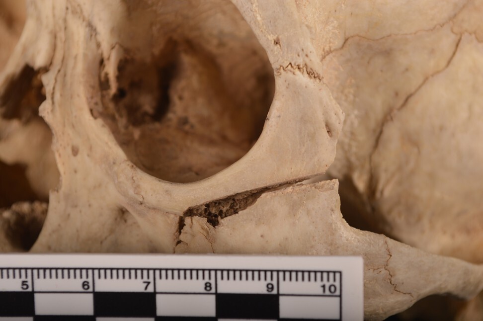 A close-up of the injuries caused by an assault 1,300 years ago. Photo credit: Qian Wang