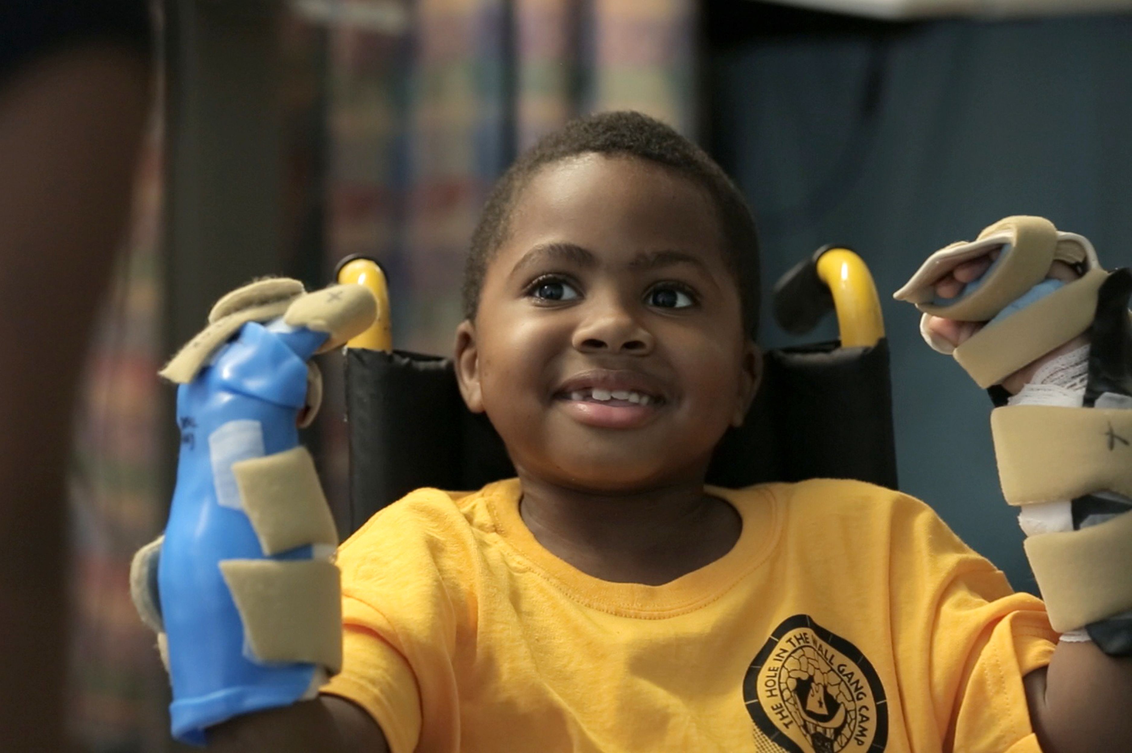 World's first child hand transplant is a 'success', declares doctors - YP |  South China Morning Post