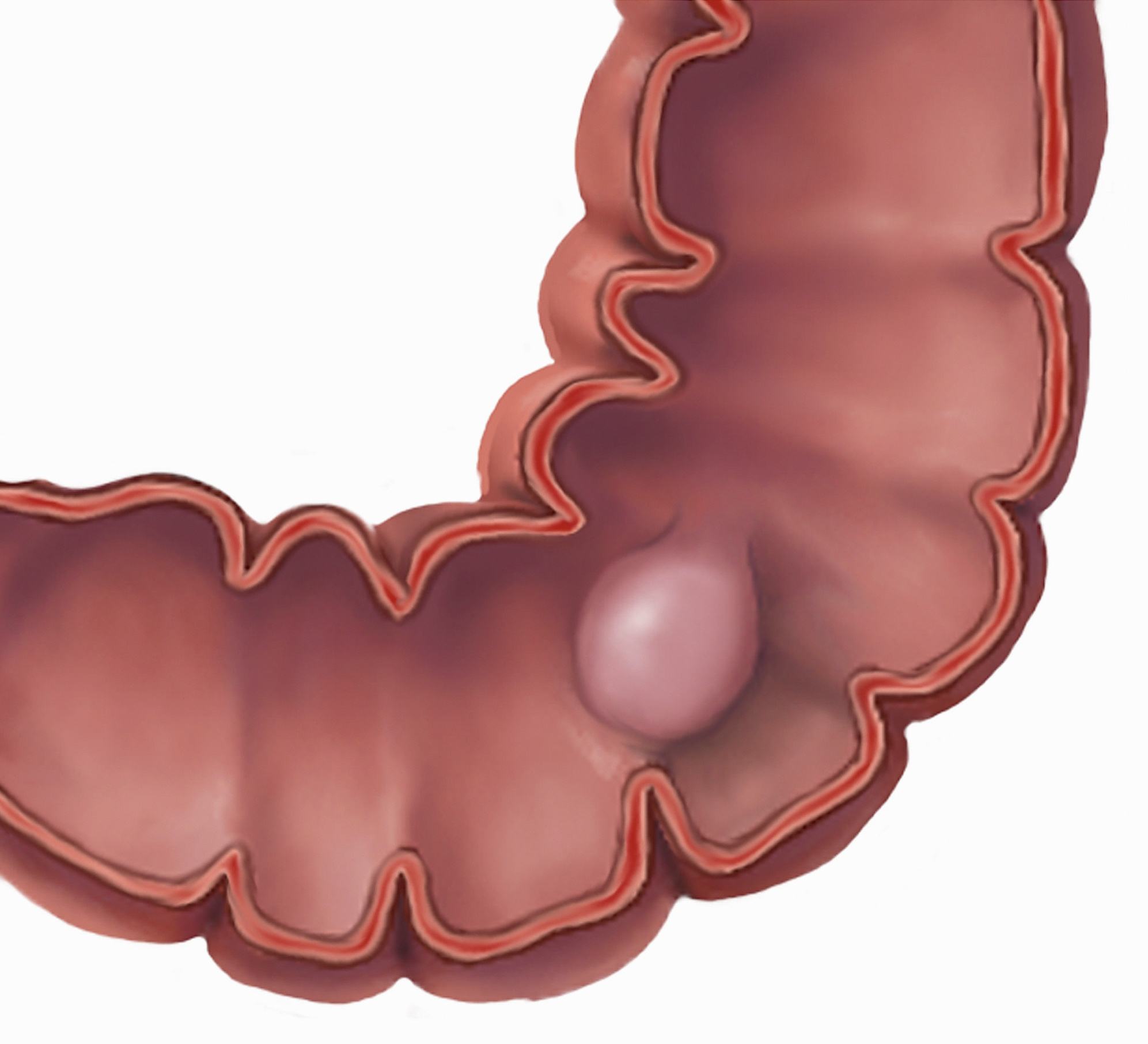 Кишки пузыри и желудки. Синдром проницаемости кишечника. Схему жкт кишечника. Дивертикулы сигмовидной кишки. Язва желудка и 12 перстной кишки.