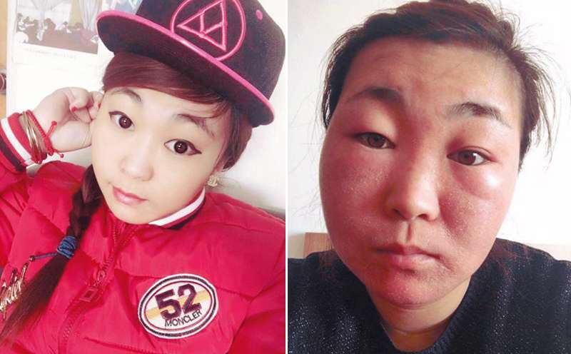 The Chinese bride-to-be (left) before she suffered the allergic reaction to make-up she wore on a photoshoot and (right) as she looks now. Photo: Shenyang Evening News