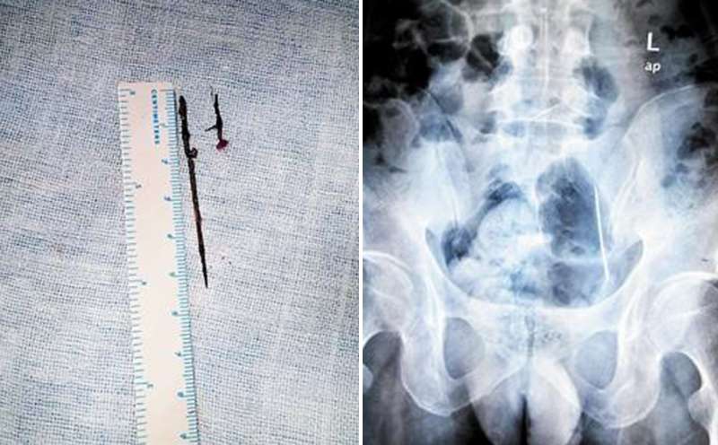 The two needles found inside a Chinese man's body (left), which were spotted after a scan carried out in hospital. Photos: Chutian Metropolis Daily