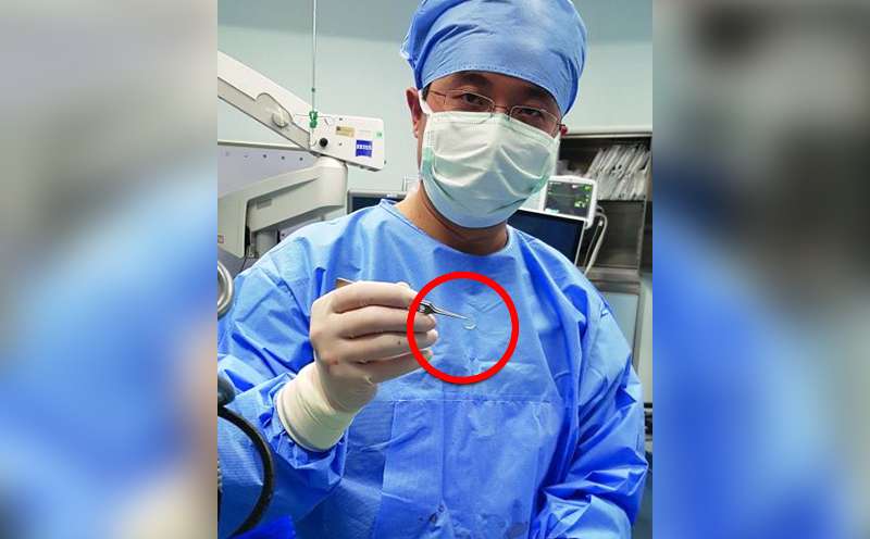 A surgeon with the cornea used in the transplant. Photo: Sina.com