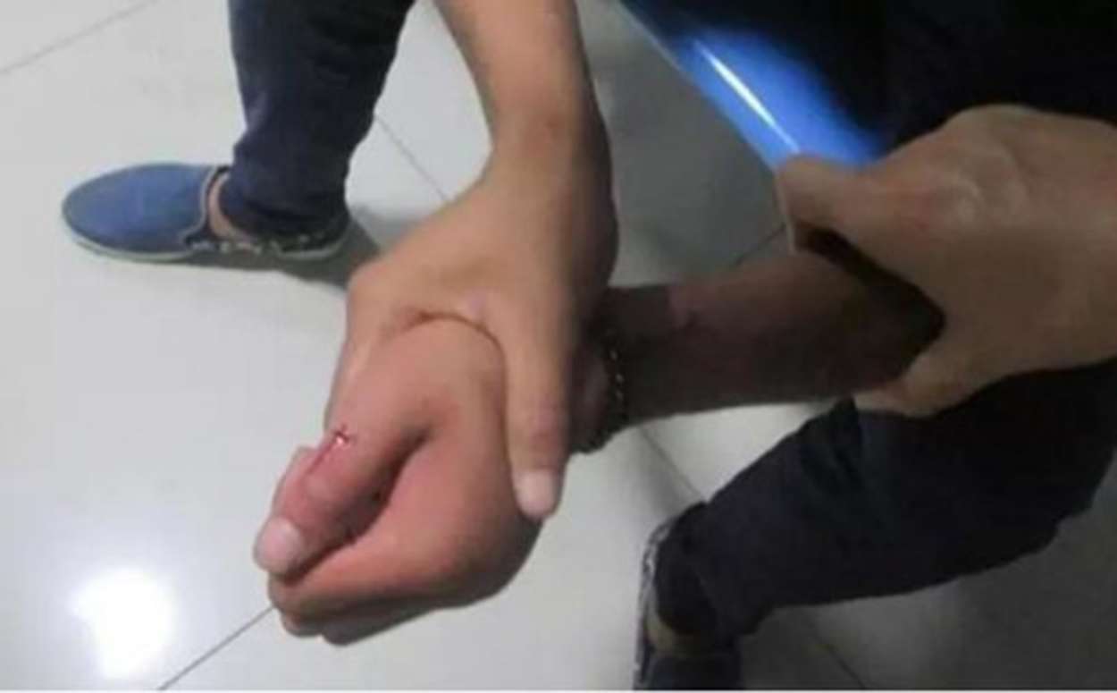 A photograph from the live online feed showing the wound on the teenager’s thumb caused by the snake bite. Photo: SCMP Pictures