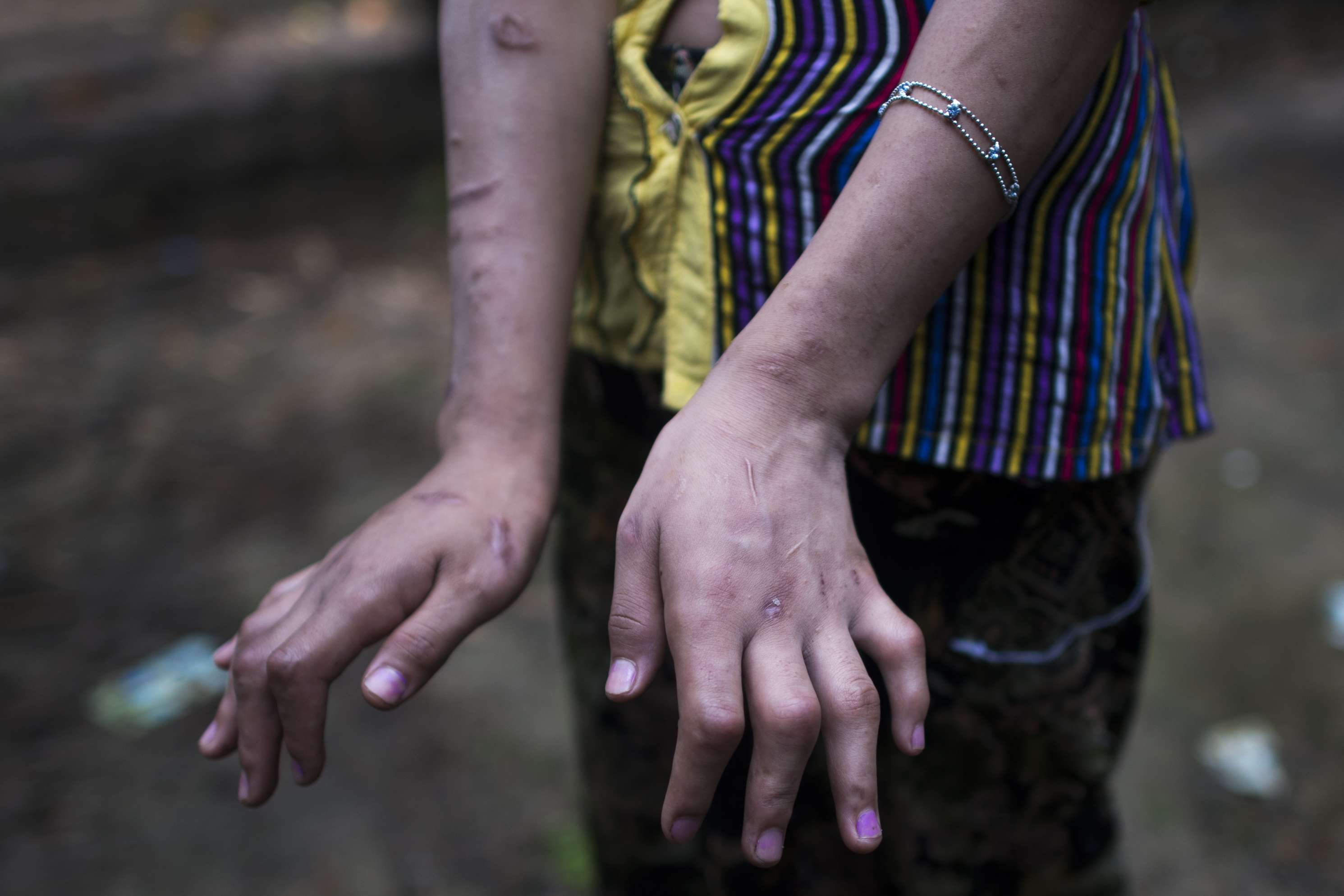 San Kay Khine, a 17-year-old Myanmar child slave shows her scarred arms and twisted fingers whilst recovering in her family's village in Baw Lone Kwin, Kawmu township located outside Yangon. Photo: AFP