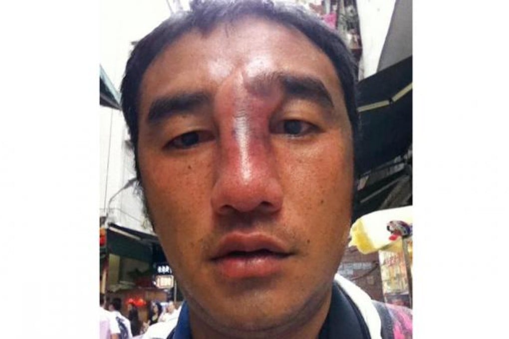 Felix Wong shows his bruises.