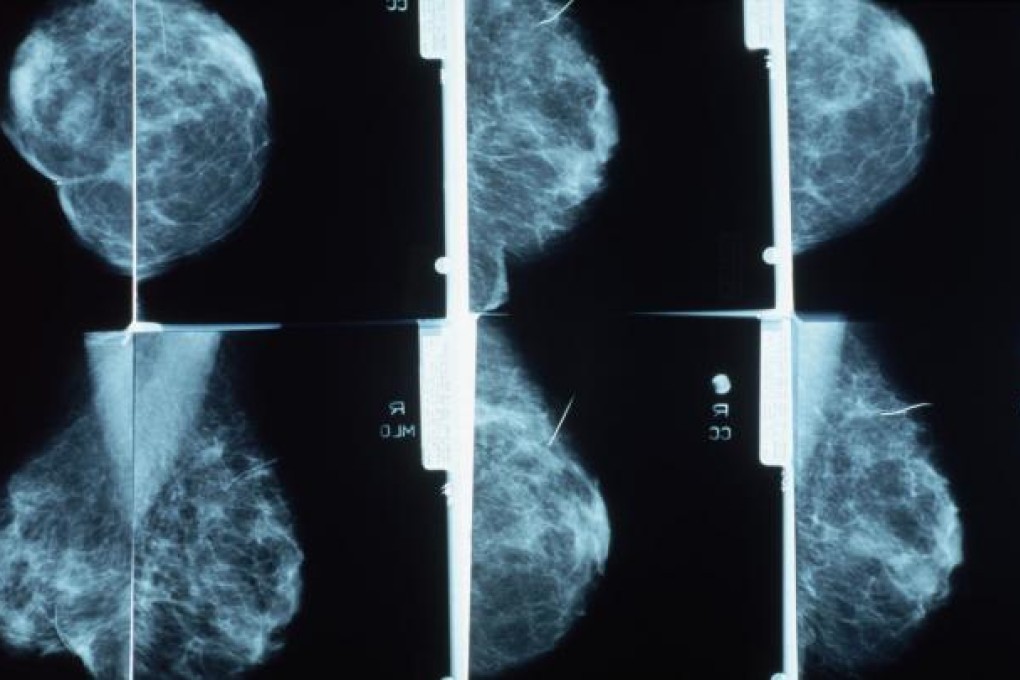 Breast-cancer screening saves 1,300 women yearly. Photo: CORBIS