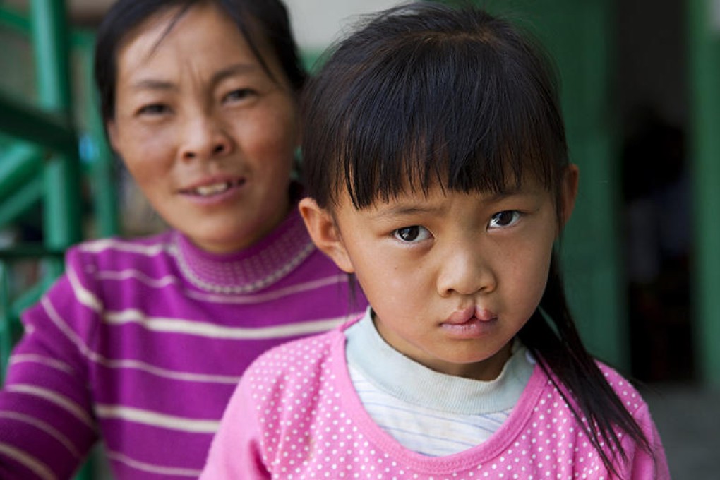 Yang Yan, from Yunnan province, before her operation. Photo: Peter Stuckings