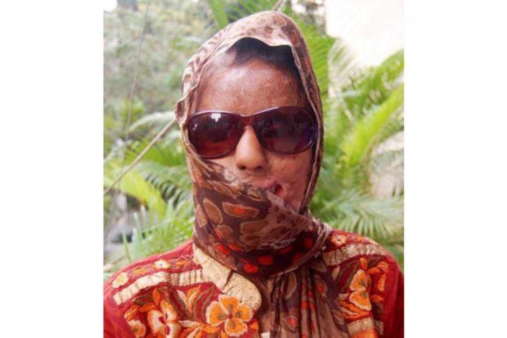 Sonali Mukherjee was blinded in the attack. Photo: SCMP