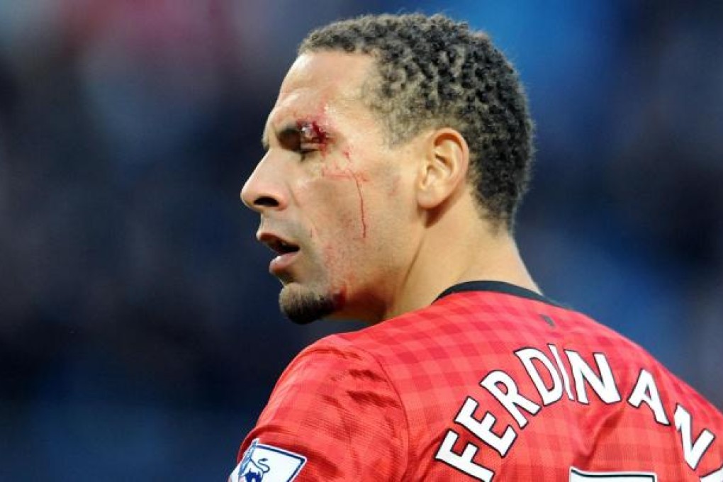 A bloodied Rio Ferdinand after he was hit by a coin thrown from the crowd. Photo: AP