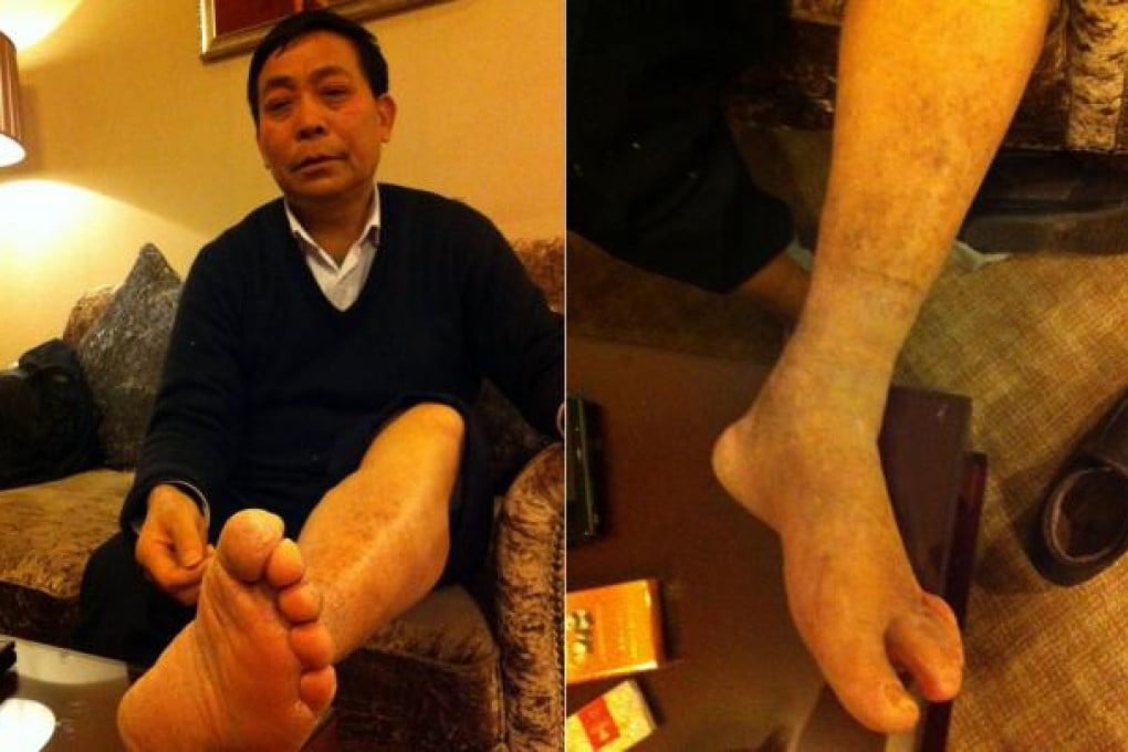 Chongqing businessman Chen Guixue shows the bruises which he says were left after his beating at the hands of police sent by Bo Xilai. Photos: SCMP