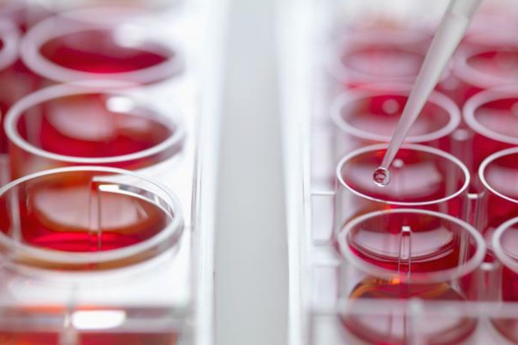 Stem cell treatment left woman with bone growing around one eye
