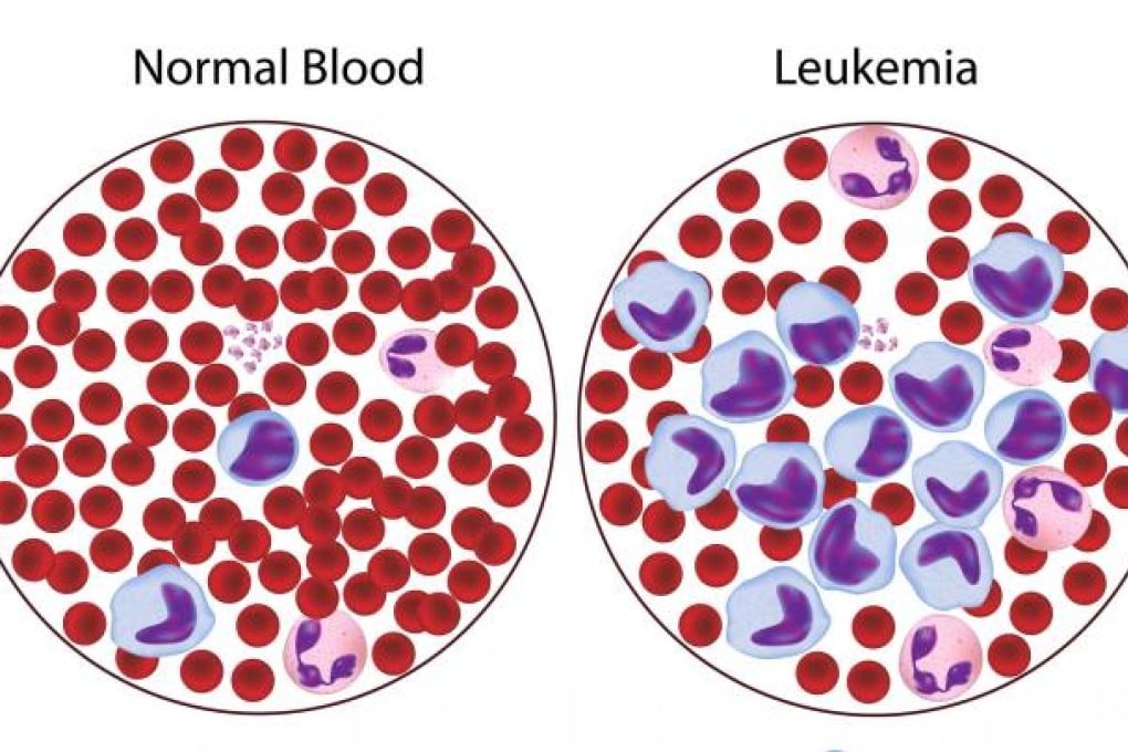 CML affects about 0.8 to 1 per 100,000 people in Hong Kong