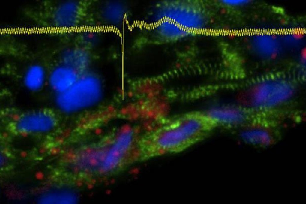 Patients' skin cells were used to create the "disease in a dish" model.