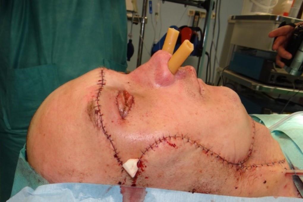 The patient after his transplant surgery. Photo: AFP