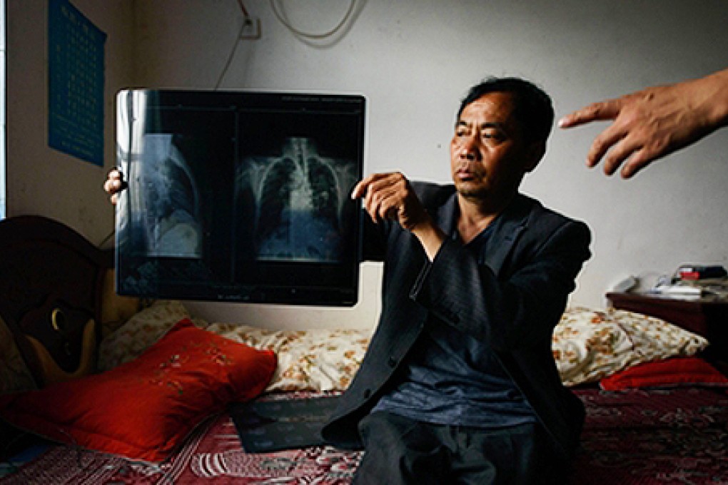 A migrant worker diagnosed with pneumoconiosis shows his chest X-ray. Photo: SCMP Pictures