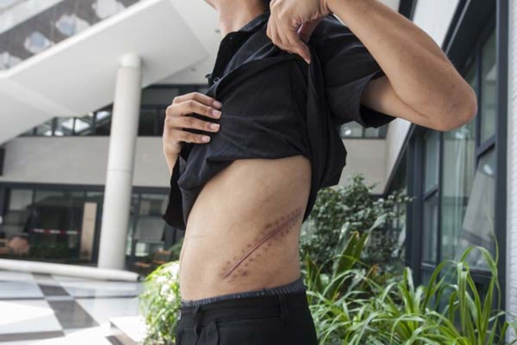 Whistleblower Li Wei shows the scars from his illegal kidney removal operation. Photo: Screenshot via Chutian Metropolis Daily