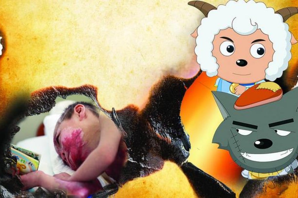 Two children get severely burned while mimicking a popular cartoon.