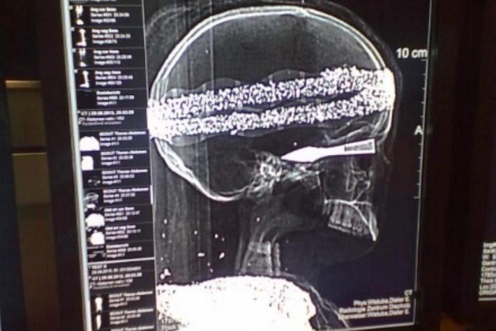 An X-ray shows the skull with headband and arrow. Photo: EPA