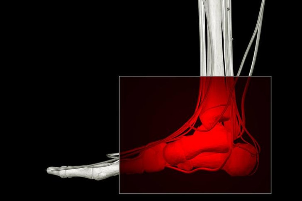 High heels a key culprit in ankle sprains