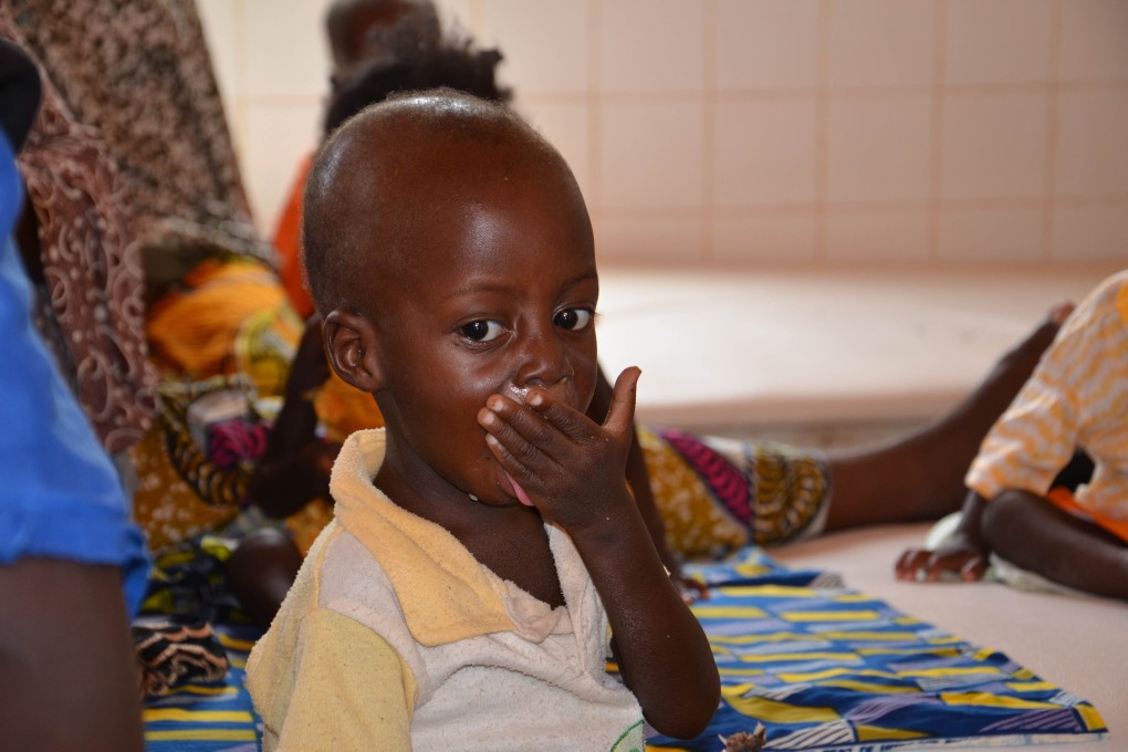 An African child suffering from malnutrition. Photo: AFP