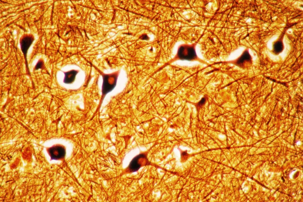 Scientists at Baptist University are hoping to find a cure for neurological disorders like Parkinson's disease by injecting patients with their own healthy brain stem cells for repairs.