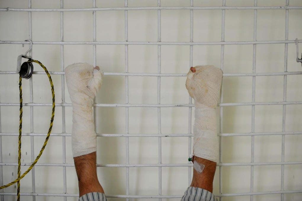 Patients such as this Afghan burns victim may no longer be able to receive help if hospitals and clinics are forced to close. Photo: AFP