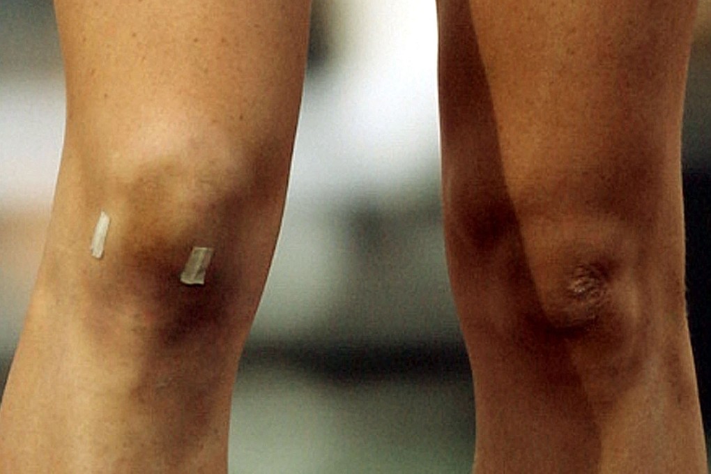 The knees of Australia's world champion Jana Pittman, who underwent arthroscopic surgery on her right knee less than two weeks before the 2004 Olympics. Arthroscopic surgery on the meniscus is the most common orthopaedic procedure in the United States. Photo: AP