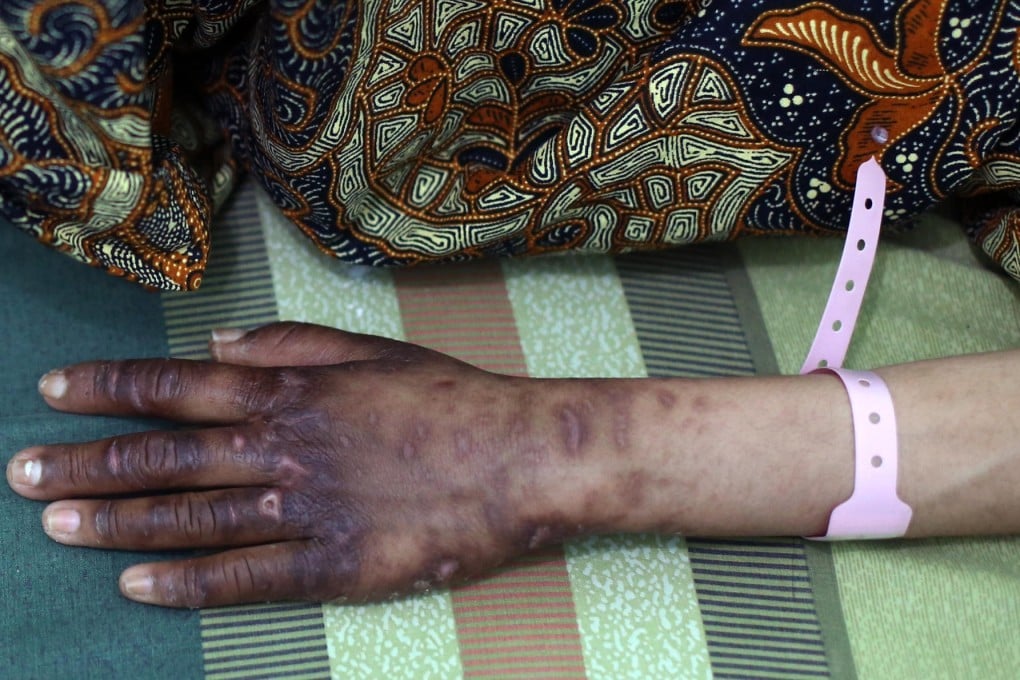 Erwiana Sulistyaningsih shows some of her injuries at the hospital in Indonesia where she is being treated. Photo: Sam Tsang